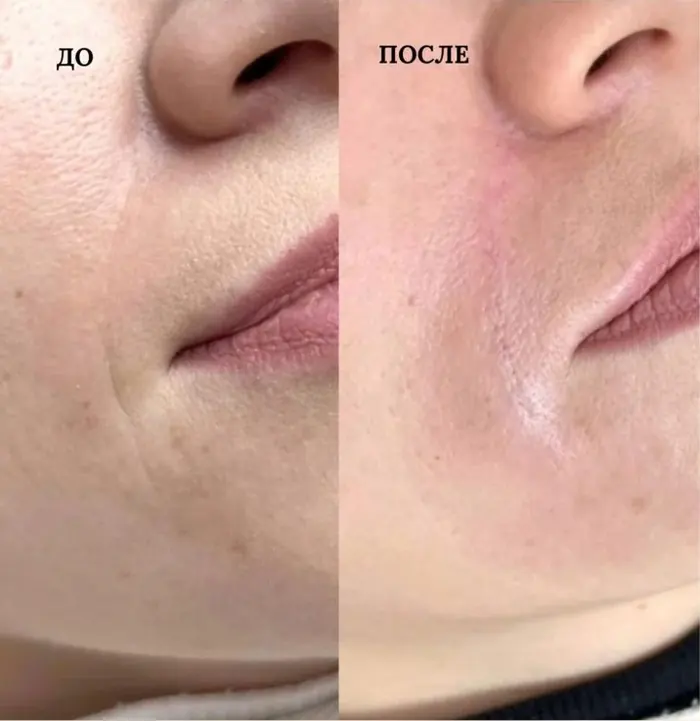 Коррекция овала лица, фото до и после, работа 3